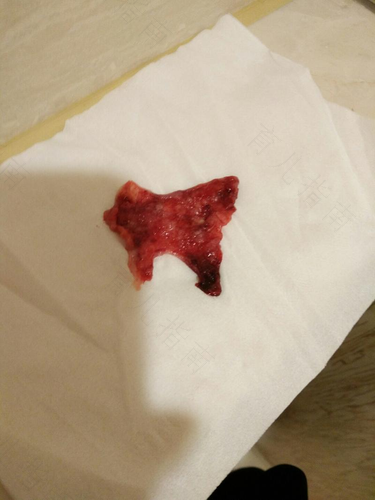 小腹疼痛出血怎么回事女性