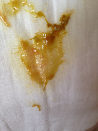 拉大便有血丝怎么办 拉大便有血丝怎么办