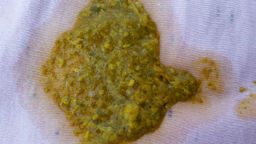 拉出果冻状的大便怎么回事 拉出果冻状的大便怎么回事