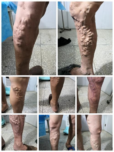 腿部有静脉曲张怎么办 腿部有静脉曲张怎么办