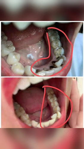 每天刷牙都出血是怎么回事还有口臭 每天刷牙都出血是怎么回事还有口臭