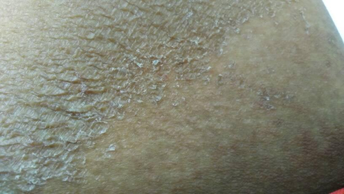 肚子上脱皮怎么回事 肚子上脱皮怎么回事