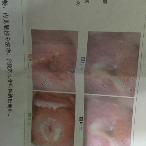 中药怎么治宫颈炎 中药怎么治宫颈炎