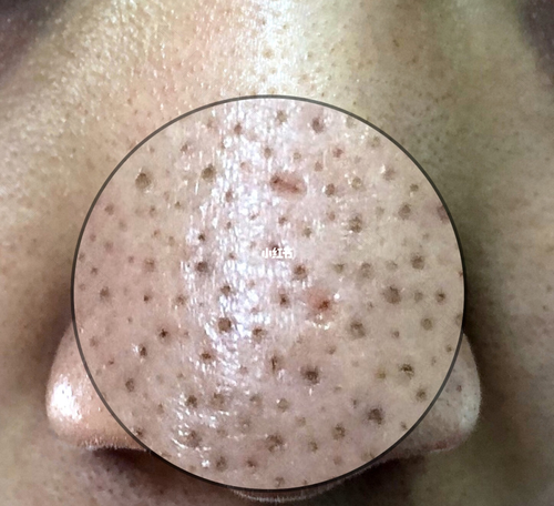 毛孔特别大怎么办 毛孔特别大怎么办