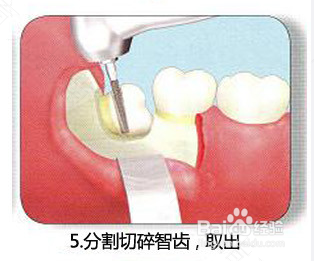 拔智齿需要验血吗hiv 拔智齿需要验血吗hiv