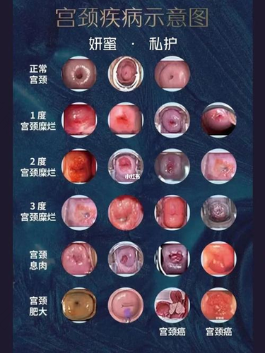 宫颈糜烂肥大会癌变吗