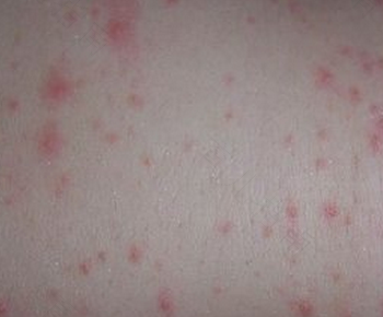 急性荨麻疹的症状和治疗方法 急性荨麻疹的症状和治疗方法