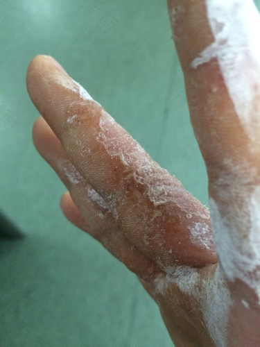 湿疹患者用什么洗澡好 湿疹患者用什么洗澡好