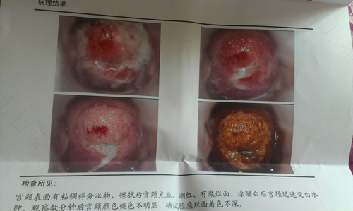 宫颈糜烂手术后能看出来吗 宫颈糜烂手术后能看出来吗