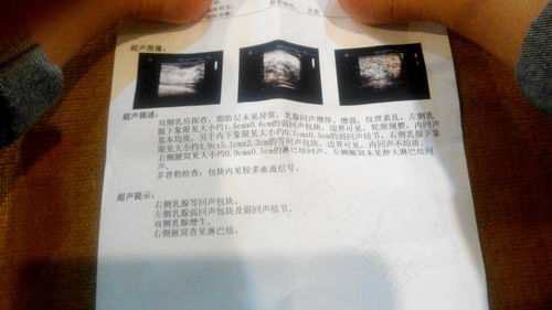 浆乳脓肿畏寒 浆乳脓肿畏寒