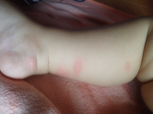 发烧起疙瘩怎么回事