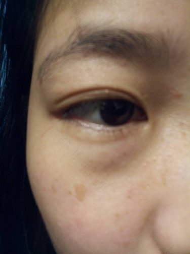 脸上黄褐斑怎么形成的 脸上黄褐斑怎么形成的