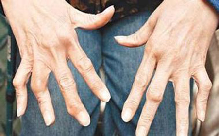 关节炎风湿怎么治疗