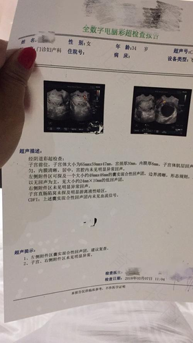 子宫右侧附件区囊性回声是怎么回事