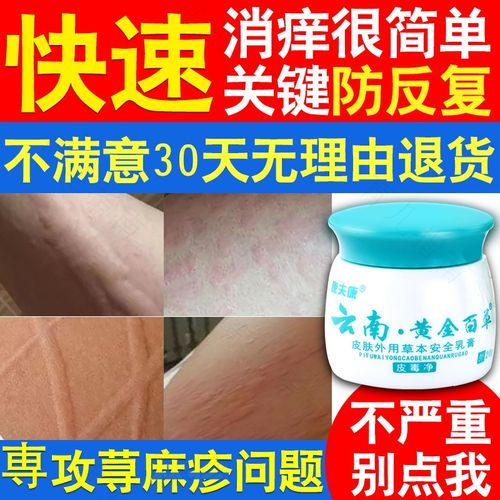 皮肤瘙痒症怎么治疗 皮肤瘙痒症怎么治疗