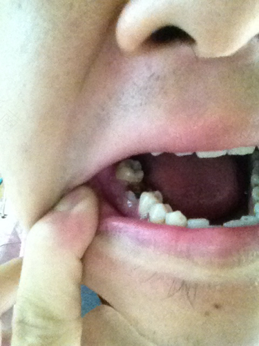 两颗门牙中间烂了怎么办 两颗门牙中间烂了怎么办