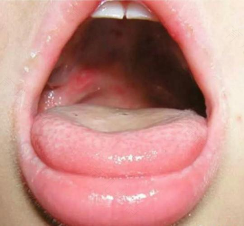 宝宝患上口腔溃疡怎么办 宝宝患上口腔溃疡怎么办