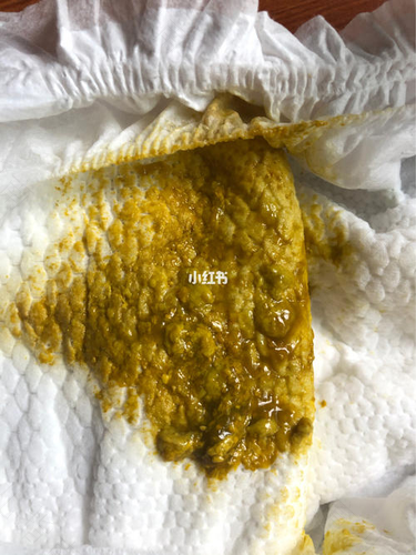 总拉大便不成形怎么回事 总拉大便不成形怎么回事