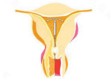 子宫腺肌病不治会癌变吗 子宫腺肌病不治会癌变吗