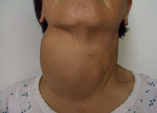 甲状腺纤维瘤的症状