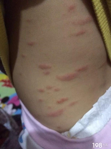 春季全身痒是怎么回事怎么治疗 春季全身痒是怎么回事怎么治疗