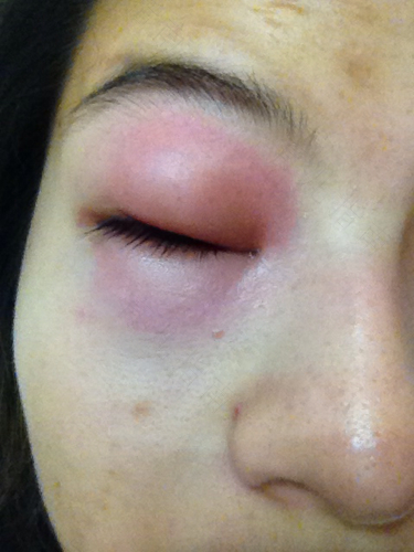 眼部感染症状 眼部感染症状