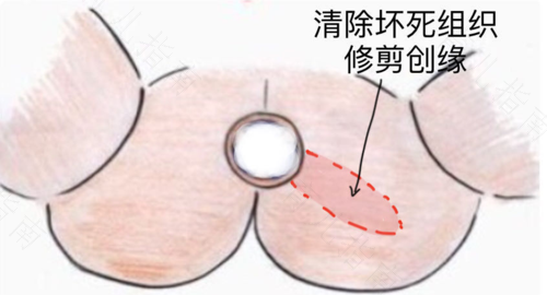 肛周硬块怎么治疗 肛周硬块怎么治疗