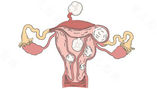 女生子宫左侧痛是怎么回事 女生子宫左侧痛是怎么回事