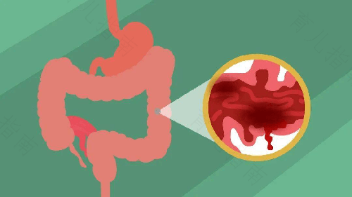 病毒感染肠炎怎么治疗 病毒感染肠炎怎么治疗