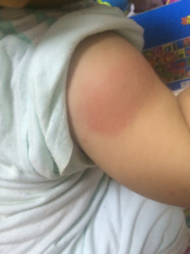 打疫苗手臂肿了痒怎么办 打疫苗手臂肿了痒怎么办