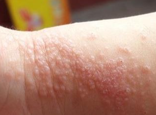 湿疹初期症状有什么感觉 湿疹初期症状有什么感觉