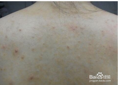 胸前和后背长痘痘怎么治疗