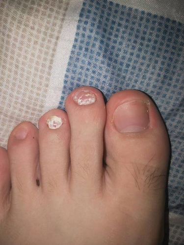 脚指甲全白了怎么回事 脚指甲全白了怎么回事