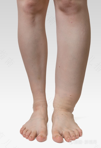 糖尿病小腿水肿怎么办 糖尿病小腿水肿怎么办