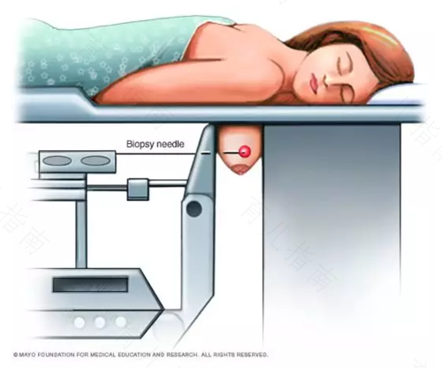 做乳房穿刺痛吗 做乳房穿刺痛吗