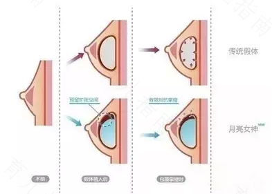 副乳对女人有什么危害吗 副乳对女人有什么危害吗