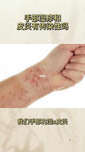 湿疹是皮肤病吗传染吗