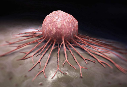 背部脂肪瘤的危害 背部脂肪瘤的危害