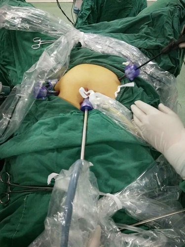 输卵管手术什么时候可以做上举