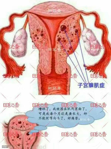 子宫腺肌症是怎样形成的 子宫腺肌症是怎样形成的