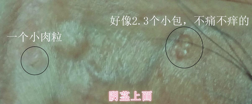 尖锐性湿疹疣可以自愈吗 尖锐性湿疹疣可以自愈吗