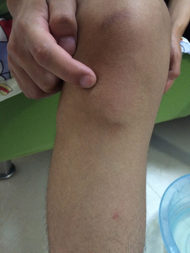 膝盖撞到了肿了怎么办,不能走路了