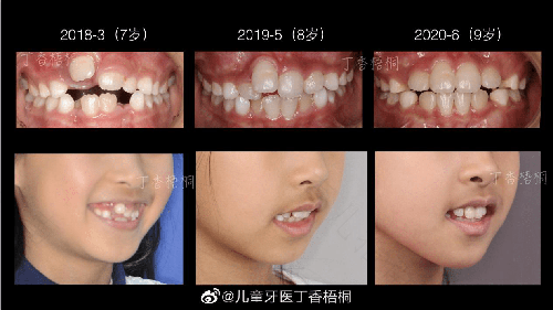 牙齿矫正拔牙有危害吗? 牙齿矫正拔牙有危害吗?