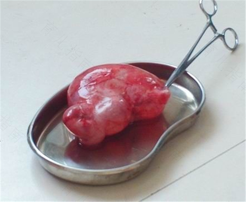 巧克力囊肿怎么治疗最好方法