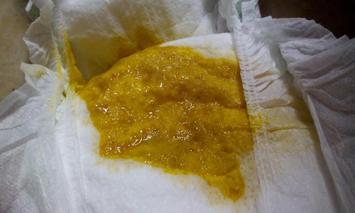 腹泻拉出泡沫怎么回事 腹泻拉出泡沫怎么回事