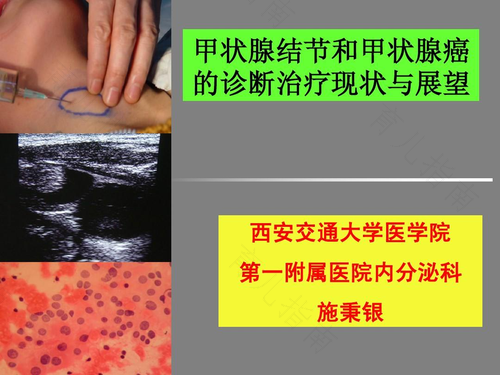 甲状腺结节会影响血糖吗 甲状腺结节会影响血糖吗