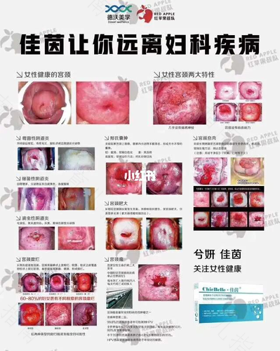 没流过产会得宫颈糜烂吗 没流过产会得宫颈糜烂吗