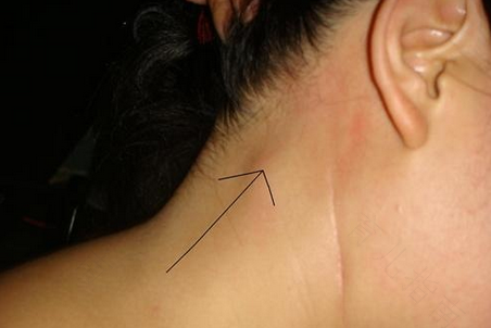 宝宝脖子淋巴结肿大怎么办 宝宝脖子淋巴结肿大怎么办