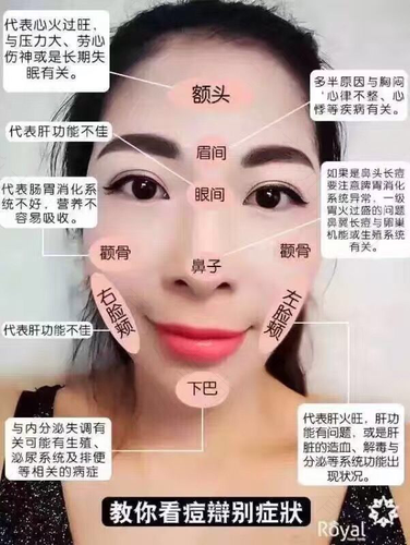 长痘痘是因为上火吗 长痘痘是因为上火吗