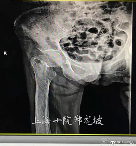 股骨头怎样引起的 股骨头怎样引起的